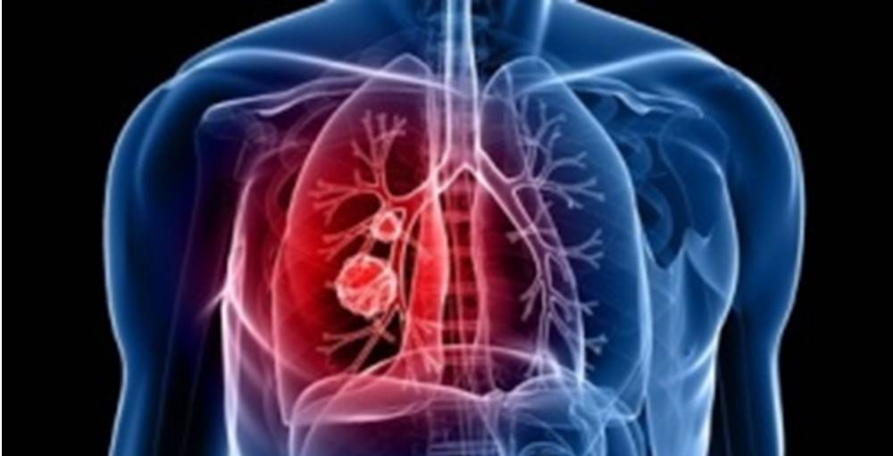 個別化医療の時代（上）　肺がん薬物療法は…　 遺伝子解析でオーダーメードが効く