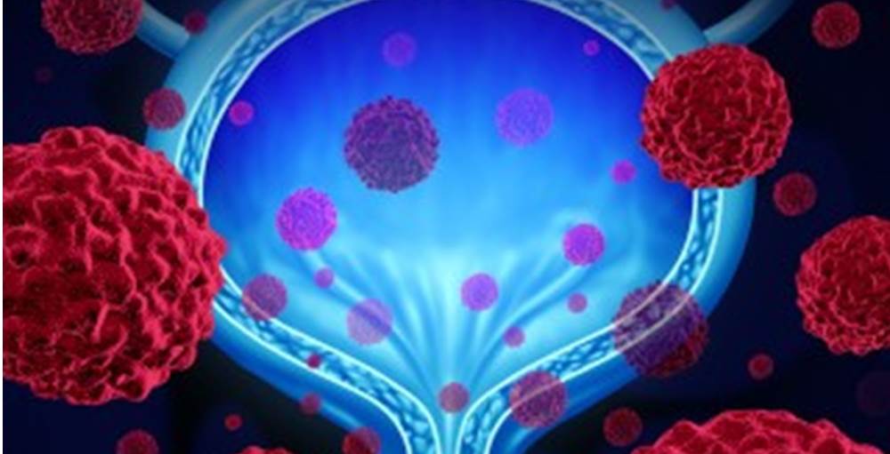 ペムブロリズマブが進行性尿路上皮がんに効果