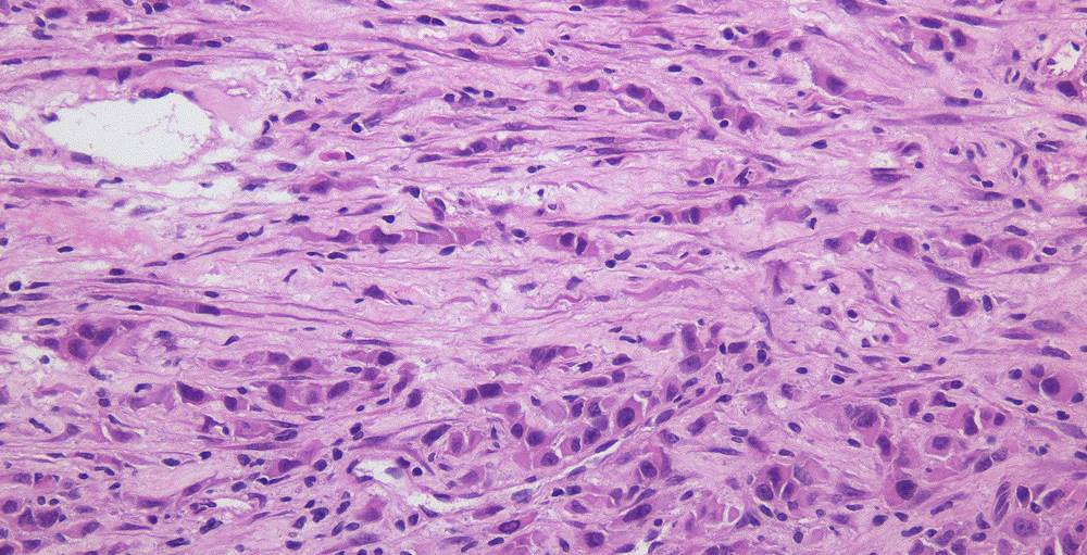 悪性中皮腫の腫瘍増大に関わる原因物質PGRNとGRN様タンパク質を特定－兵庫医大
