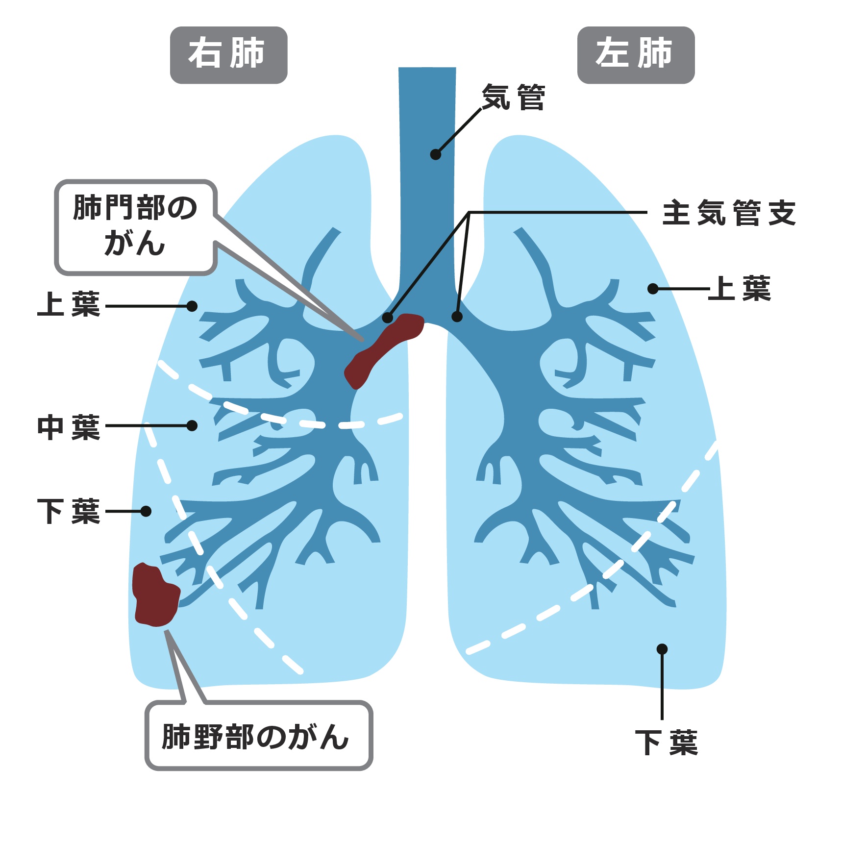 小細胞肺がんとは 疾患情報 がん情報サイト オンコロ