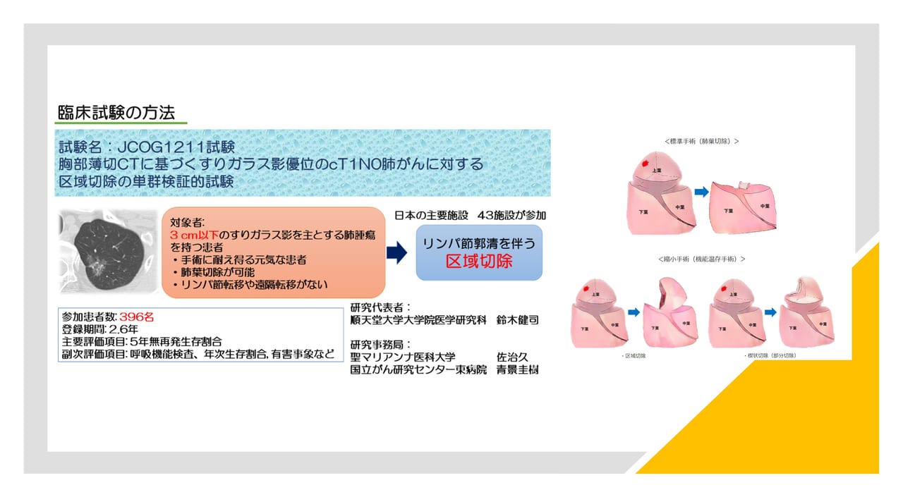 3cm以下の早期肺がんに対する区域切除の有用性を証明、標準治療の第一 