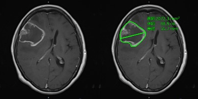 AI技術で神経膠腫の疑いのある領域を抽出：治療前画像評価の精度向上に期待